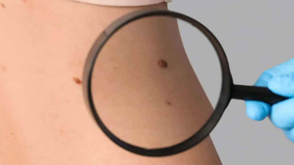 Mole Checker App: Powerful Safety Secrets 3 The Importance of Early Detection and Self-Monitoring