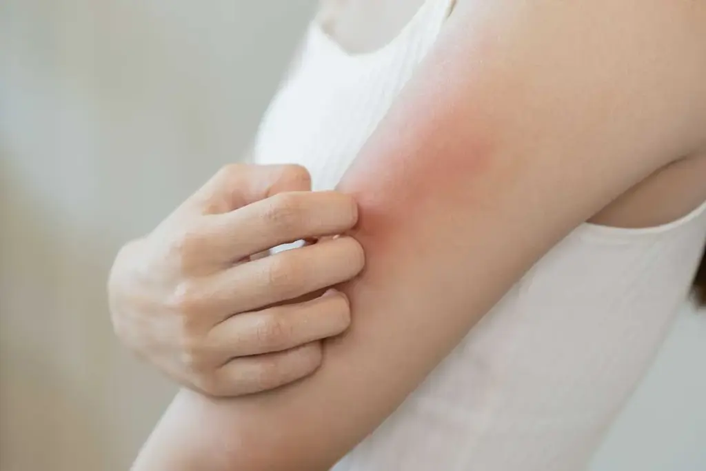 What Does an Allergic Reaction Rash Look Like? A Visual Guide with Pollen Allergy Skin Rash Pictures 3 Pollen Allergy Skin Rash Pictures and Environmental Allergens
