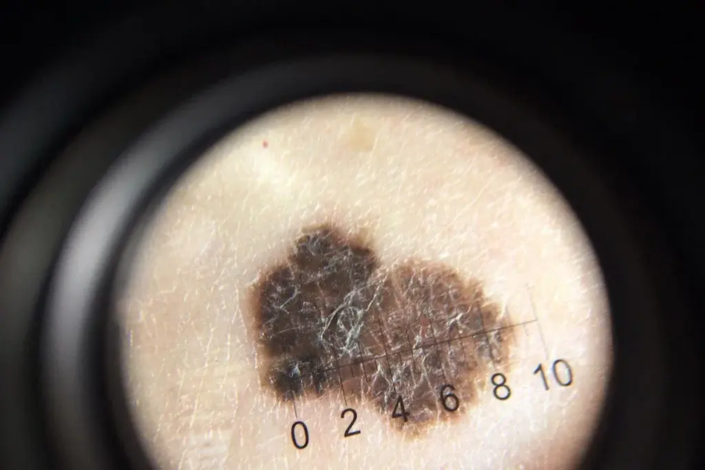 How to Treat Painful Pustules on Scalp: Quick Relief Guide 3 Feb 6454 image 3 LIV Hospital