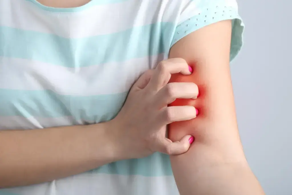 Understanding Hidradenitis Suppurativa as a Chronic Inflammatory Condition