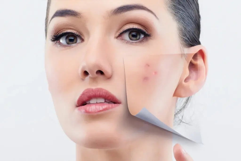 Why Herbal Medicine Works for Acne Treatment