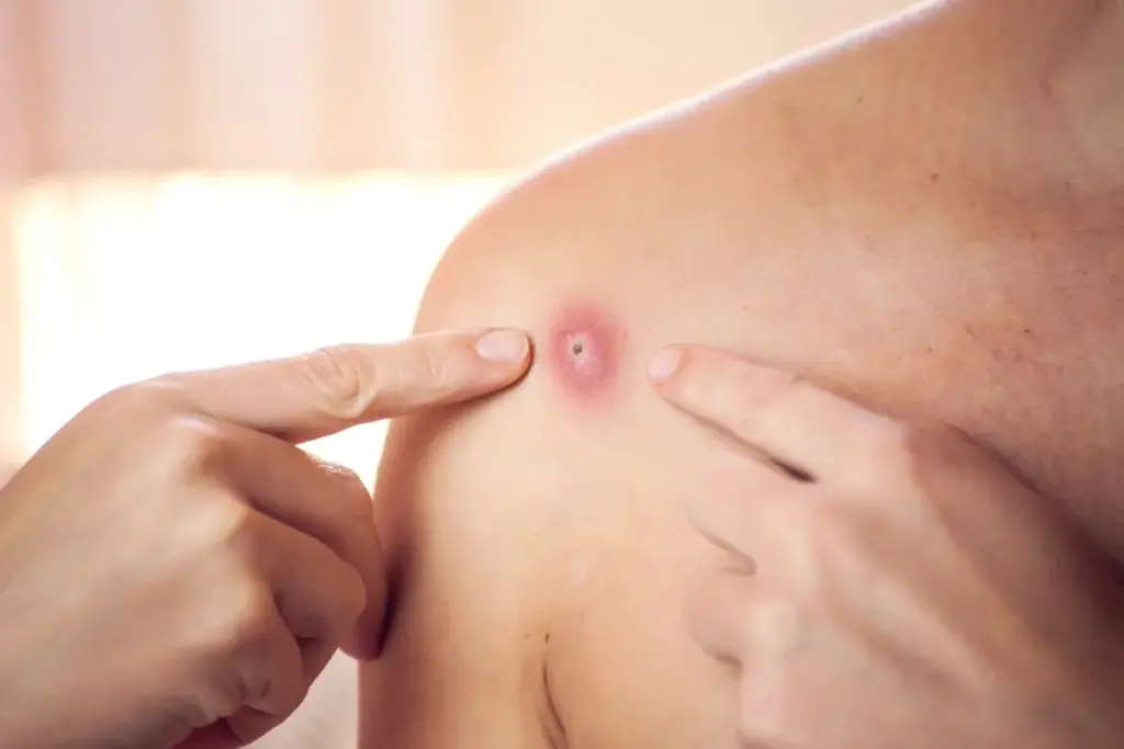 What's the Difference Between Furuncle and Carbuncle?