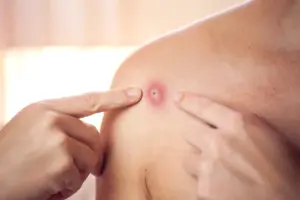 What's the Difference Between Furuncle and Carbuncle?