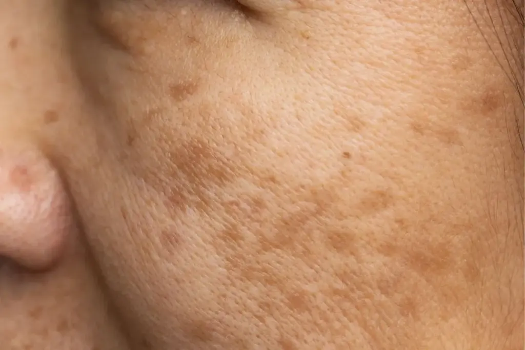 How to Treat Hyperpigmentation on Face: Complete Guide