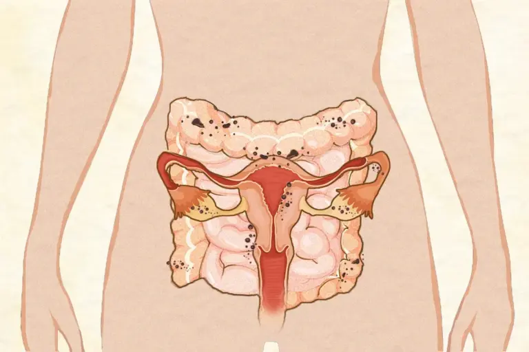 Can Endometriosis Cause Constipation and Digestive Issues?