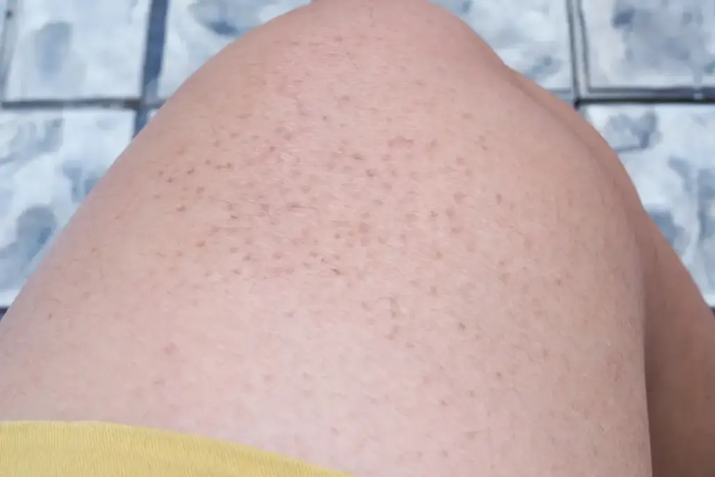 Why Do I Get Bumps on My Inner Thighs? 1 Why Do I Get Bumps on My Inner Thighs?