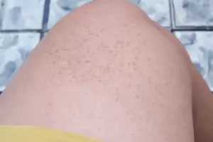 Feb 6715 image 1 LIV Hospital