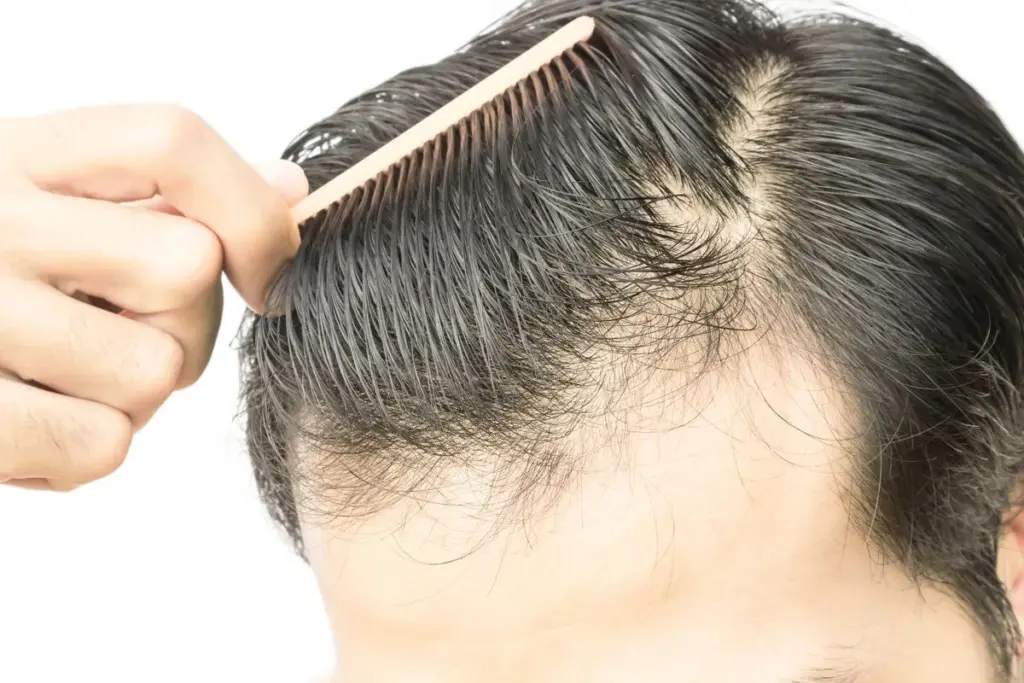 Why Does Lupus Cause Hair Loss and How to Treat It? 3 2. Effective Lupus Hair Loss Treatments and Management