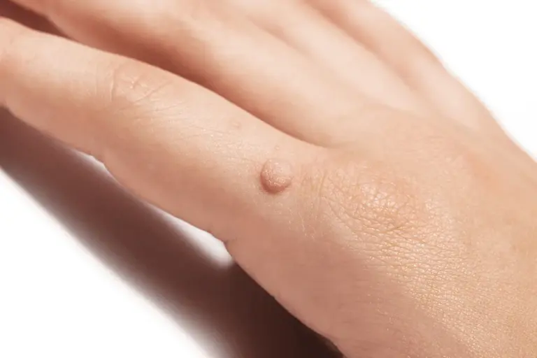 How to Stop a Bleeding Wart: Quick Solutions