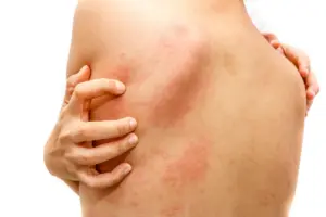Why Is My Rash Spreading All Over My Body and How Can I Stop It?