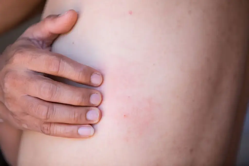 Understanding Why Your Rash on Entire Body Is Spreading
