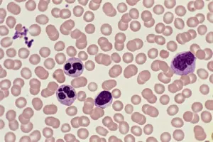 What Is the Normal Lymphocyte Range and Does High Mean Cancer?