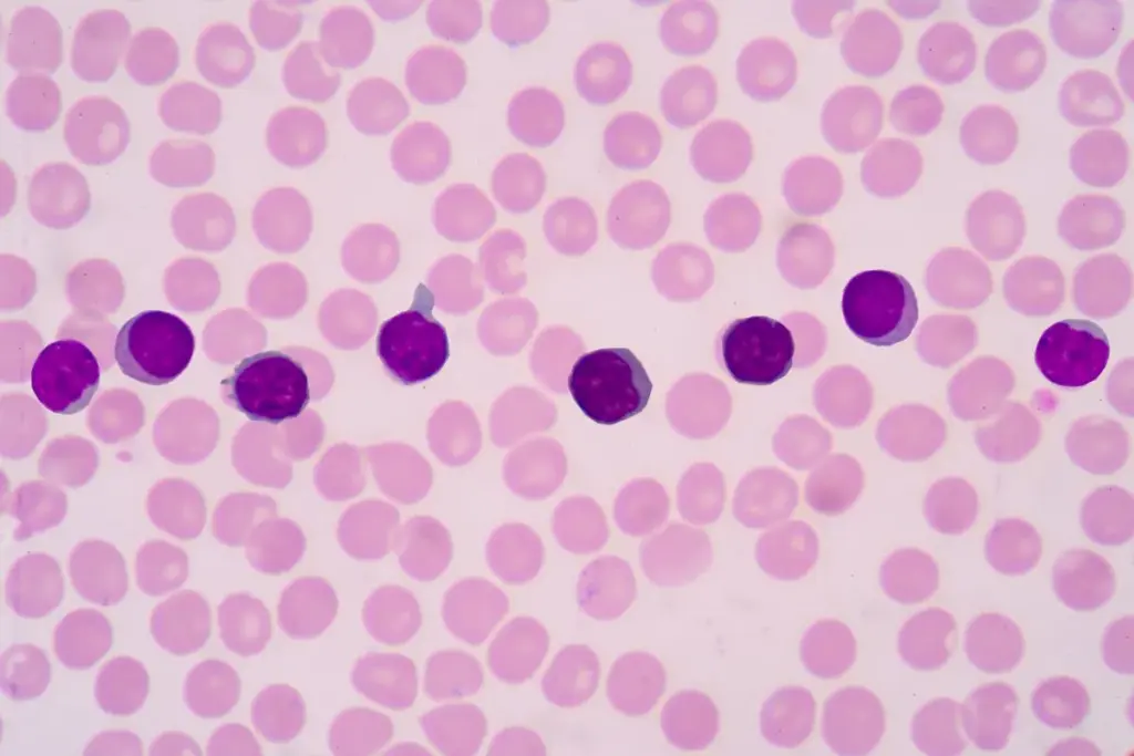 Absolute Lymphocytes High: Understanding Elevated Counts and When to Be Concerned