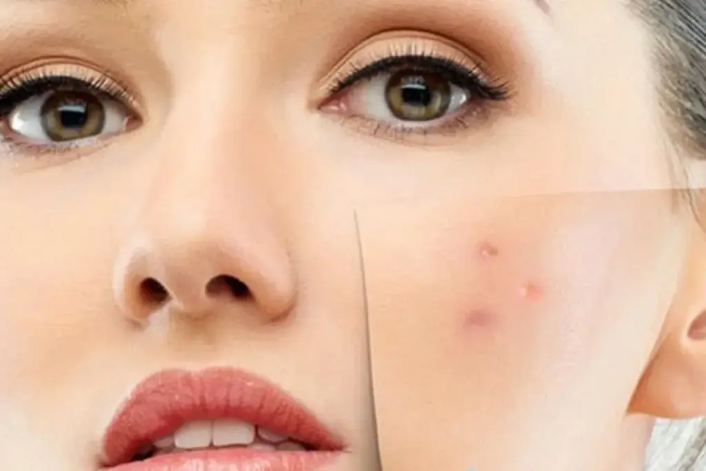 How to Shrink a Cystic Pimple Overnight: 5 Proven Methods 3 How to Shrink a Cystic Pimple Overnight: 5 Dermatologist-Backed Methods