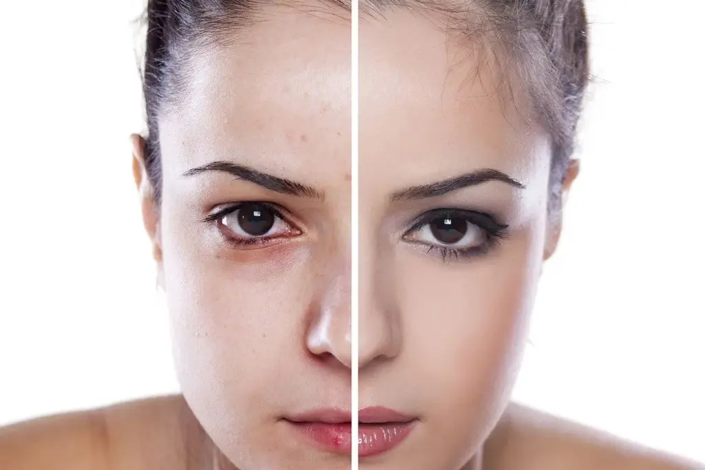 How to Remove Scars on Face: 7 Proven Treatments 2 Understanding Facial Scars and Treatment Options