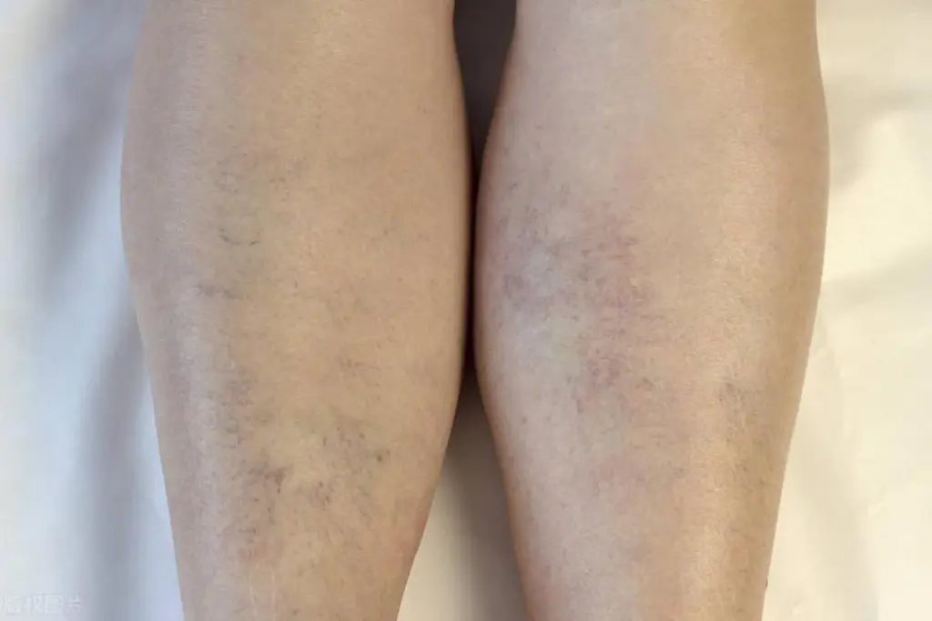 How to Remove Hyperpigmentation on Legs: Complete Guide 2 Understanding the Causes of Hyperpigmentation on Legs