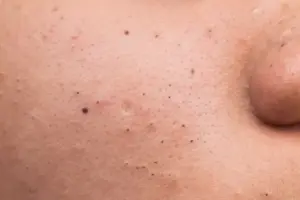 How to Remove Deep Blackheads Under Skin
