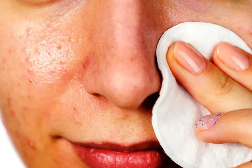 Understanding Deep Blackheads and Why They Require Special Treatment