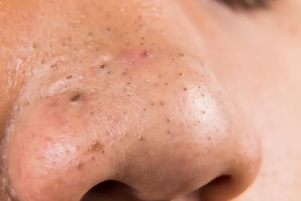 Professional Methods to Remove Deep Blackheads Safely