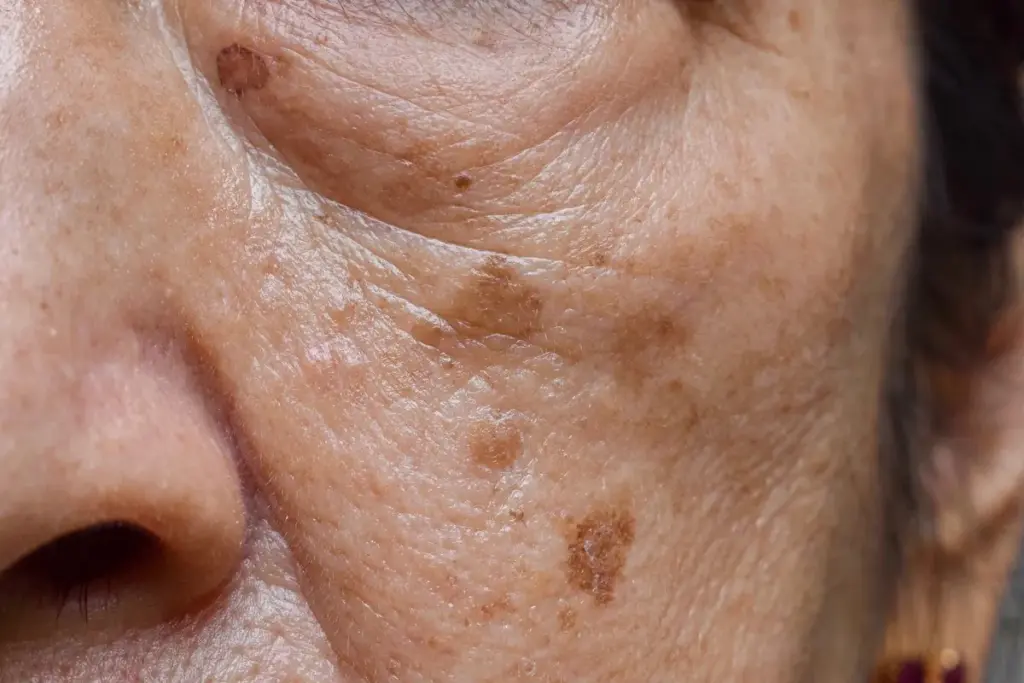 Identifying Different Types of Facial Skin Spots