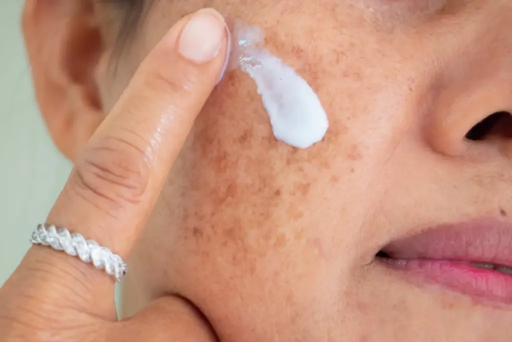 How to Remove Dark Spots on Black Skin: A Complete Guide 3 Treating Hyperpigmentation Black Skin: Professional Solutions