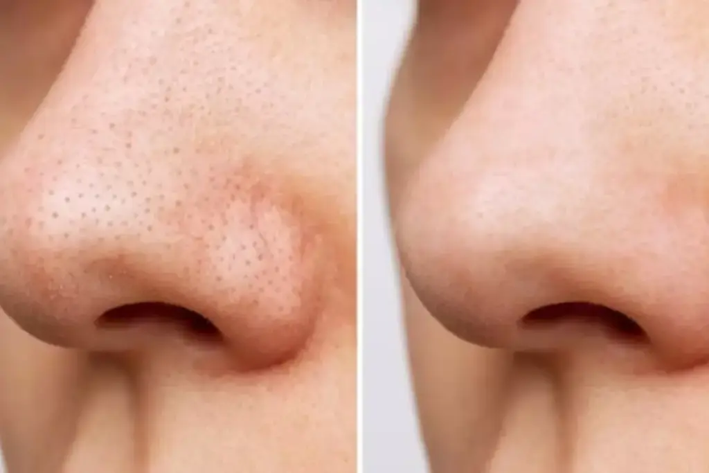 How to Remove a Stubborn Blackhead Safely 2 Understanding Why Blackheads Become Stubborn and Resist Removal