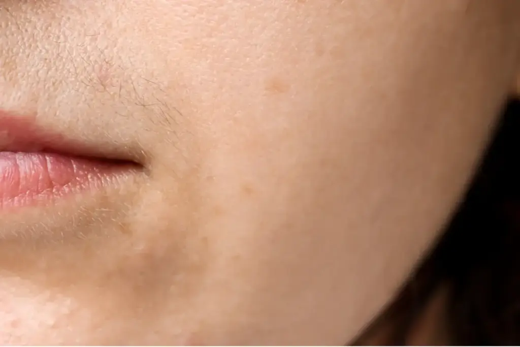 What's the Difference Between Hirsutism and Normal Hair? 1 What's the Difference Between Hirsutism and Normal Hair?