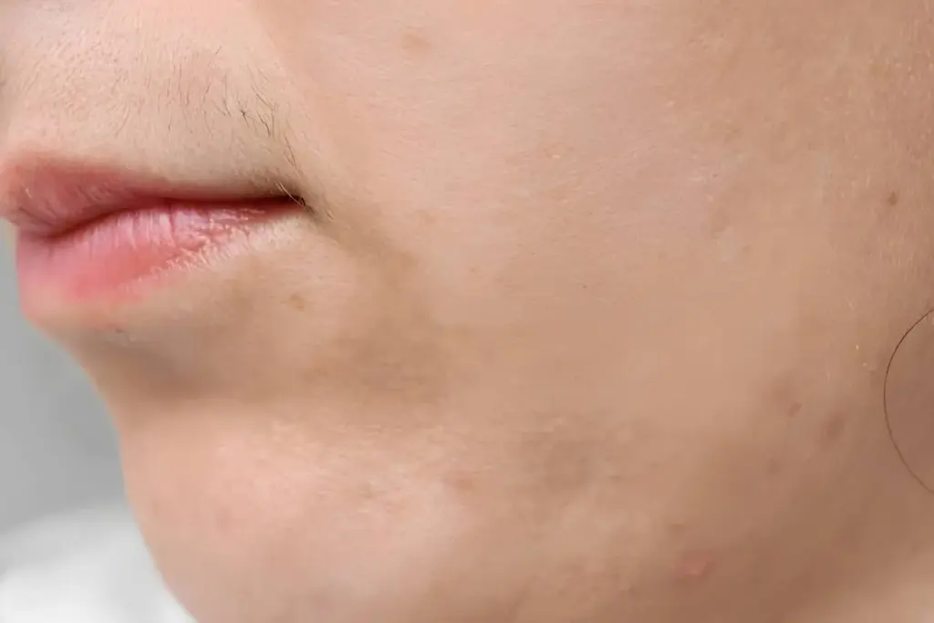 What's the Difference Between Hirsutism and Normal Hair? 2 Understanding Normal Hair Growth in Women