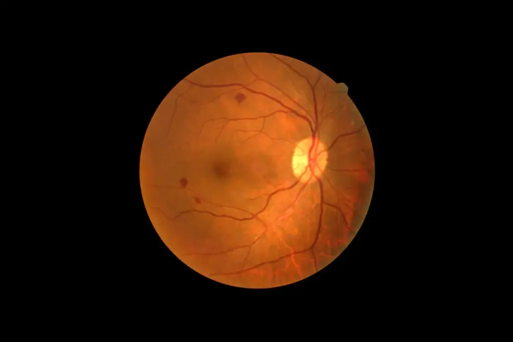 7 Types of Retinopathy: Causes, Symptoms & Treatment.