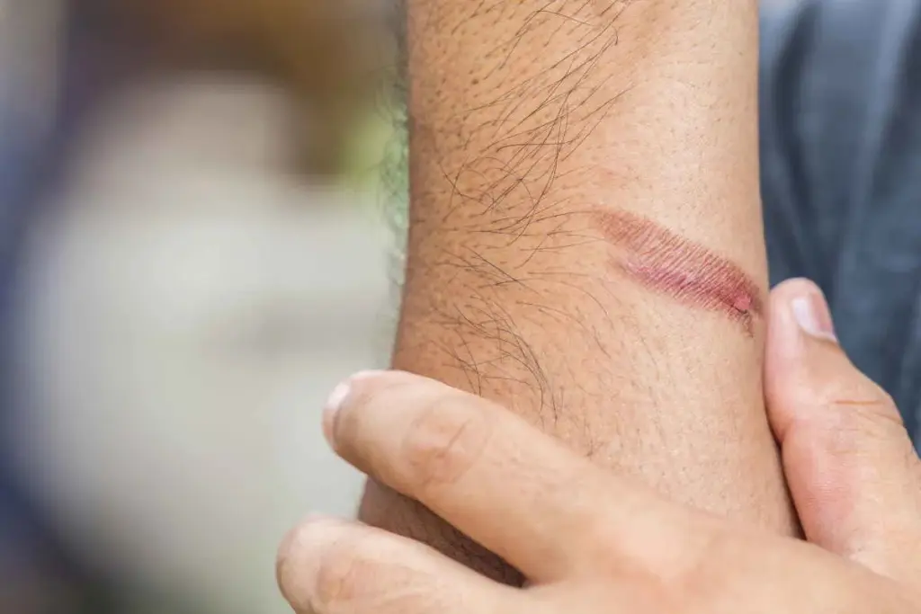 Managing and Treating a Blister on Scar Tissue