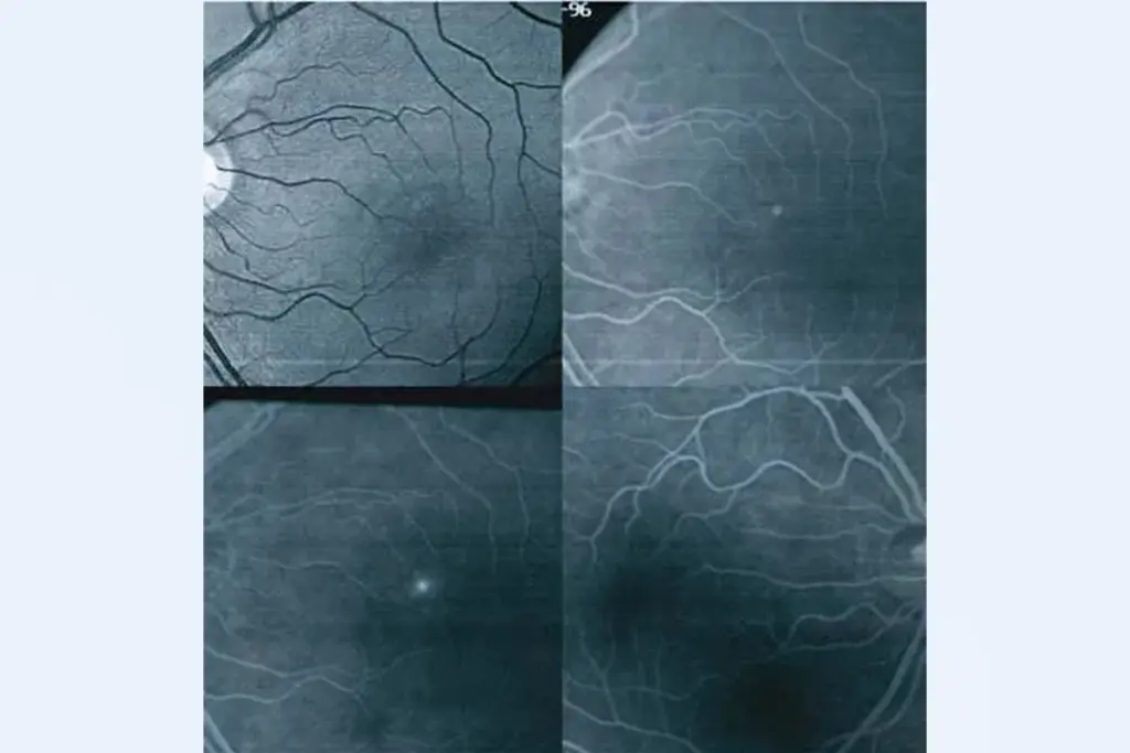 How to Use Eye Jelly Patches for Under-Eye Care.