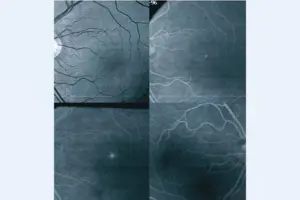 How to Use Eye Jelly Patches for Under-Eye Care.