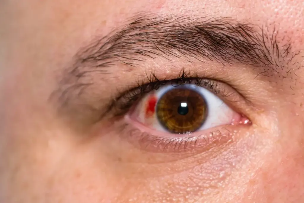 How to Treat Eye Hemorrhage: Causes and Relief.