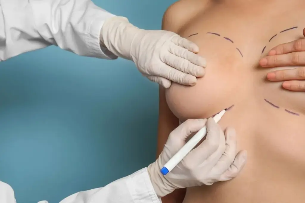 How to Choose Breast Expanders for Reconstruction.