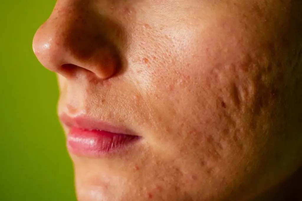 How Long Do Face Scars Take to Heal and Will They Ever Go Away?