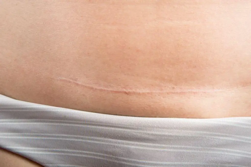 Understanding the Healing Process and How to Fade Scars from Hip Surgery